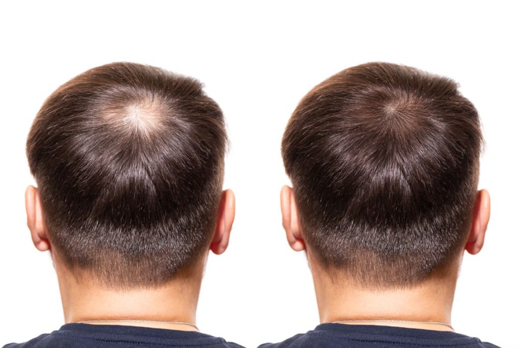 FUE Hair Transplant – Understanding the Basics