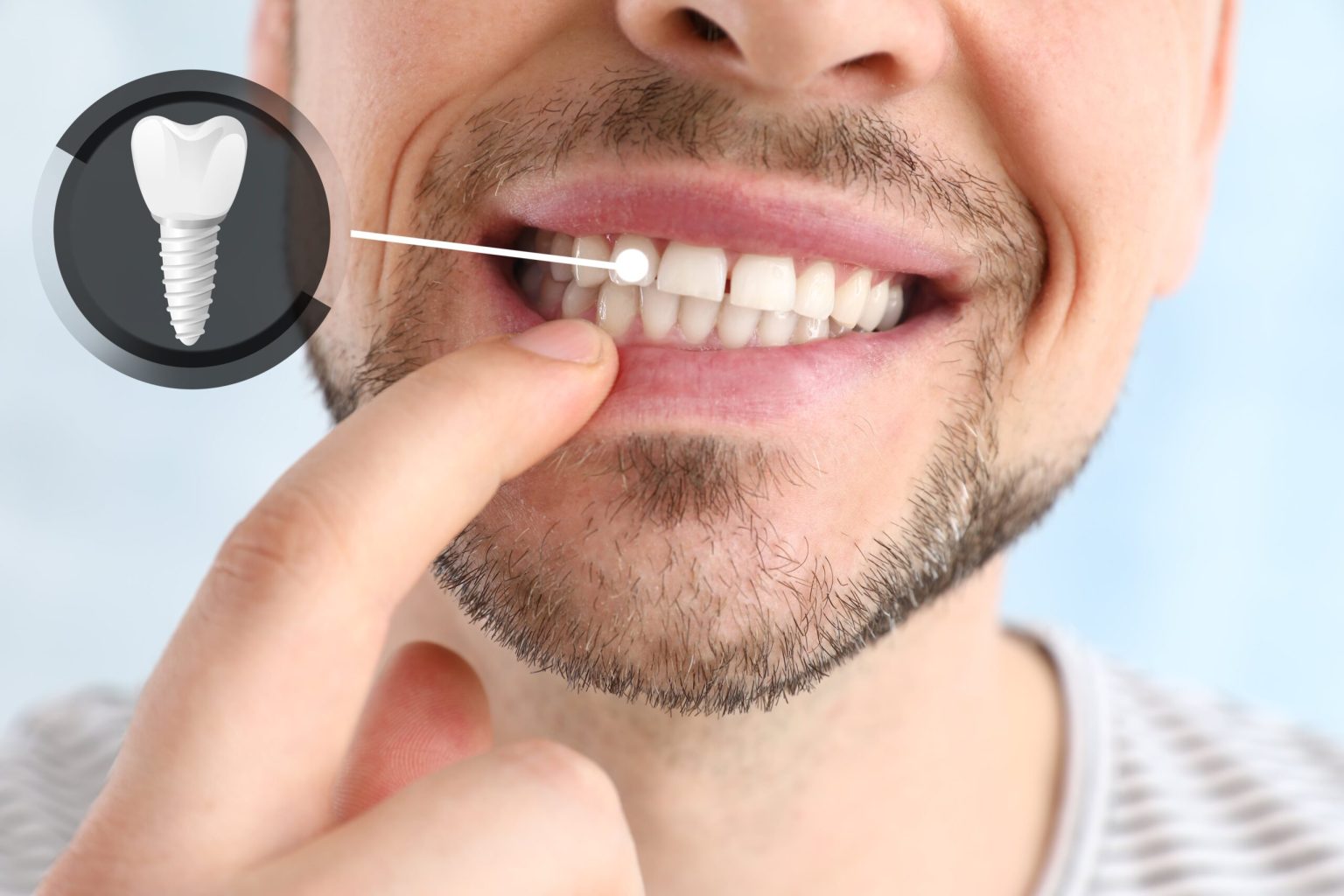 Full Mouth Dental Implants: Recovery Tips for a Smooth Healing Process